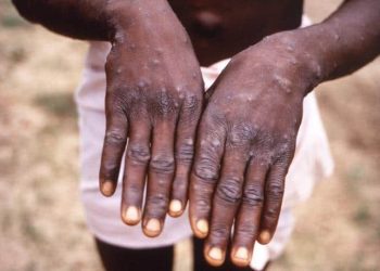 Just in:Rivers State Reports Two Confirmed Cases of Mpox