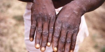 Just in:Rivers State Reports Two Confirmed Cases of Mpox