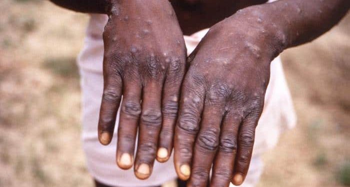 Just in:Rivers State Reports Two Confirmed Cases of Mpox
