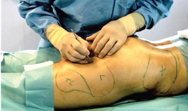 Lagos Police declares Doctor wanted After Woman Dies During Buttocks Enlargement surgery