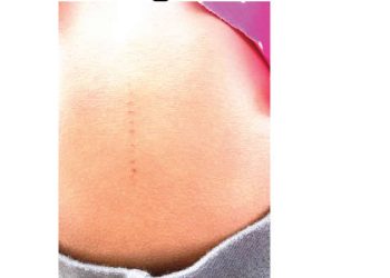 Parents tackle school over incisions on children’s bodies in Ogun