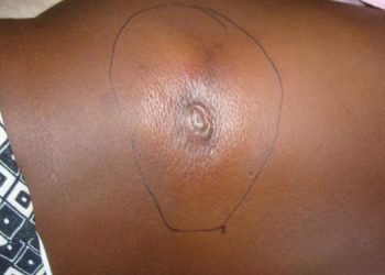 Residents Panic as Buruli Ulcer Outbreak Hits Adamawa Community