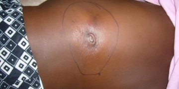 Residents Panic as Buruli Ulcer Outbreak Hits Adamawa Community