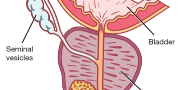 Prostate Cancer: Experts Urge Nigerian Men to Screen Early