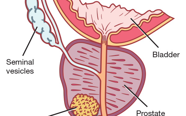 Prostate Cancer: Experts Urge Nigerian Men to Screen Early
